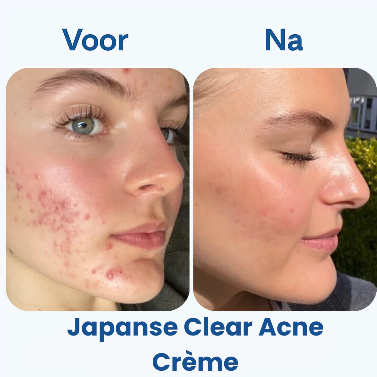 Japanse Clear Acne Crème 24g