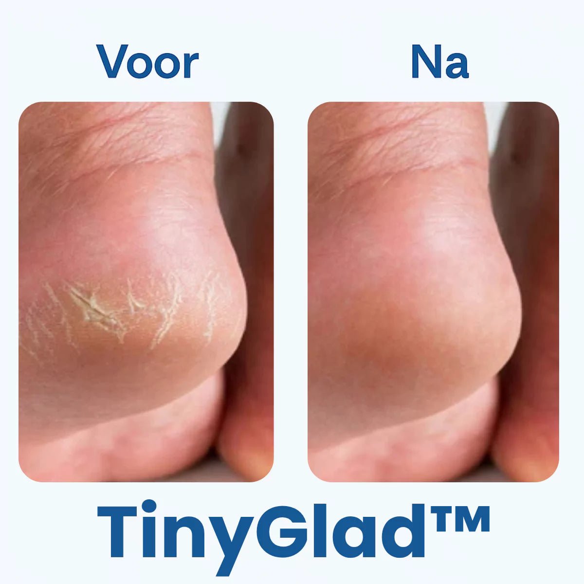 TinyGlad™ 2-in-1 Elektrische Eeltverwijderaar